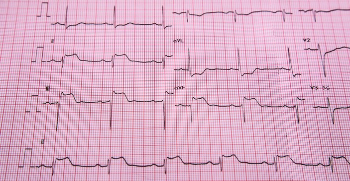 EKG - STEMI - známky ST elevácie a infarktu srdcového svalu