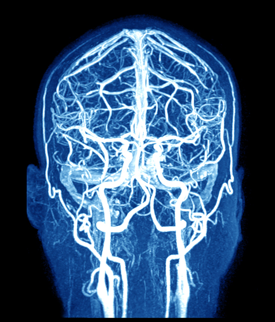 MRI mozku a mozkové cévy