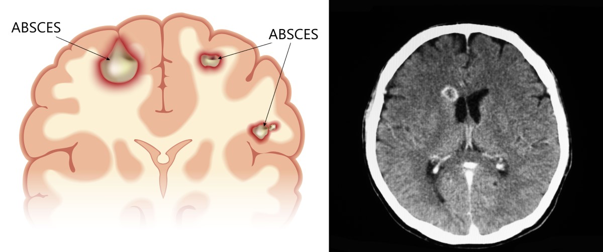 Anatomické zobrazení a CT snímků abscesu mozku