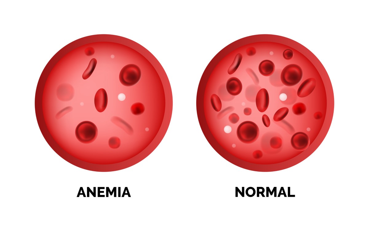 Anémie a normální hladina krevních červených buněk