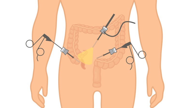 Modelové znázornění laparoskopie při apendicitidě