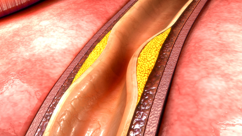 Aterosklerózou postižená céva - průřez