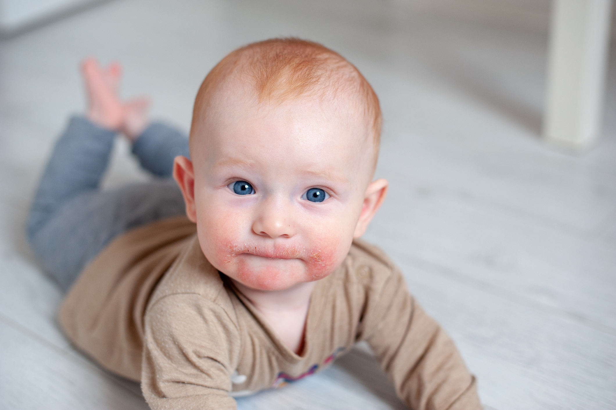 Atopická dermatitida na obličeji dítěte