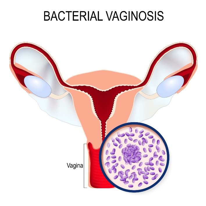 Bakteriální vaginóza a přemnožení Gardnerella vaginalis
