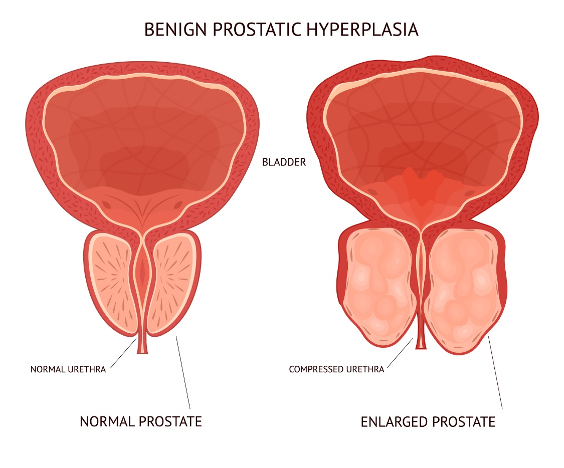 Benigní (nezhoubná) hyperplazie prostaty