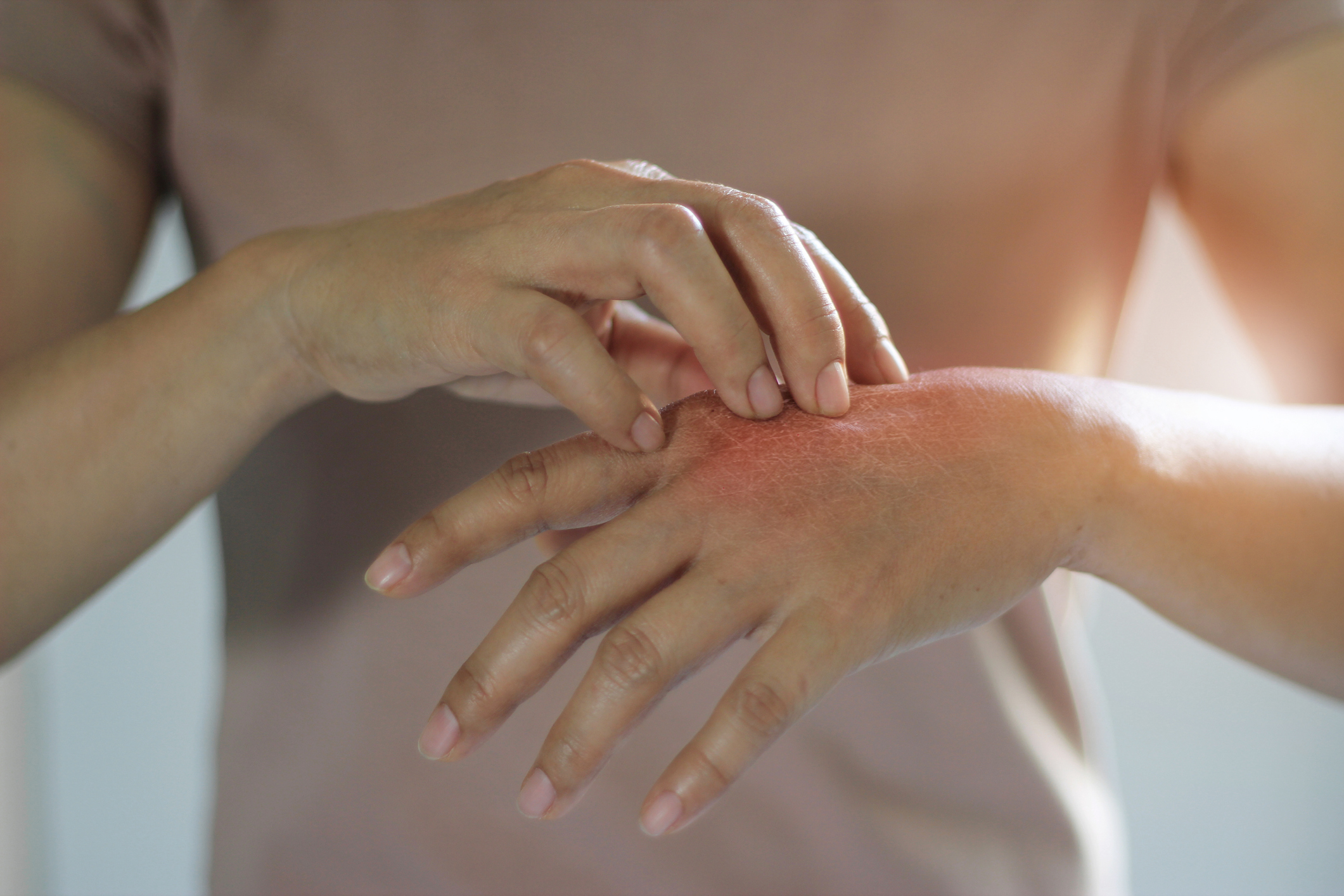 Dermatitida - svědění kůže