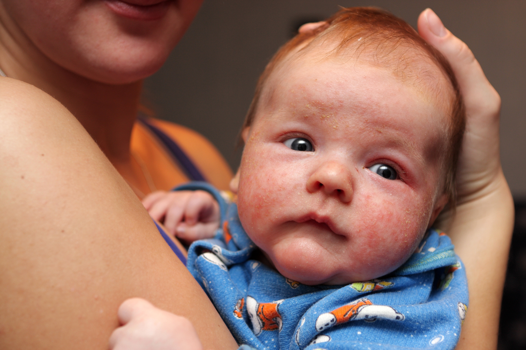 Dermatitida na obličeji malého dítěte