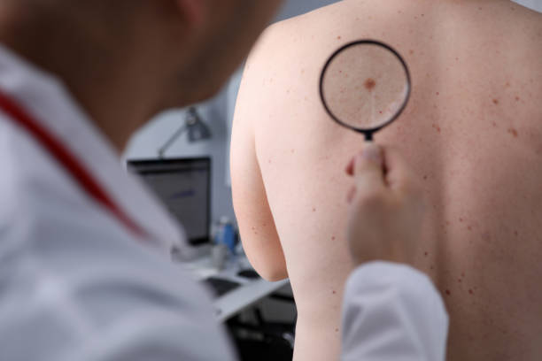 Dermatoskopie – vyšetření kožních útvarů