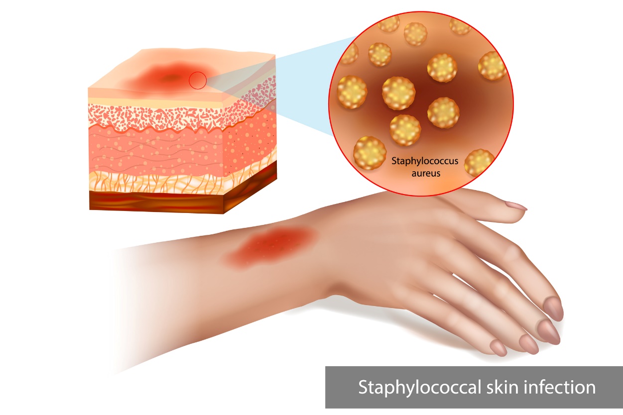 Stafylokoková kožní infekce