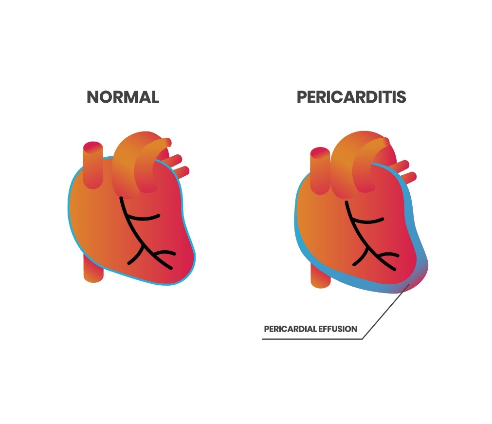 Fyziologie srdce a perikarditida (perikardiální výpotek)