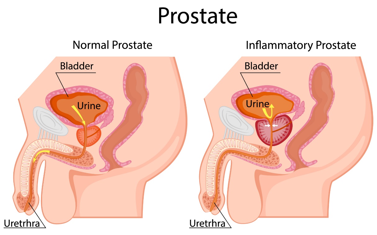 Vlevo: fyziologická prostata. Vpravo: zvětšená prostata. Lokalizovaná pod močovým měchýřem. Močový měchýř, moč, močová trubice