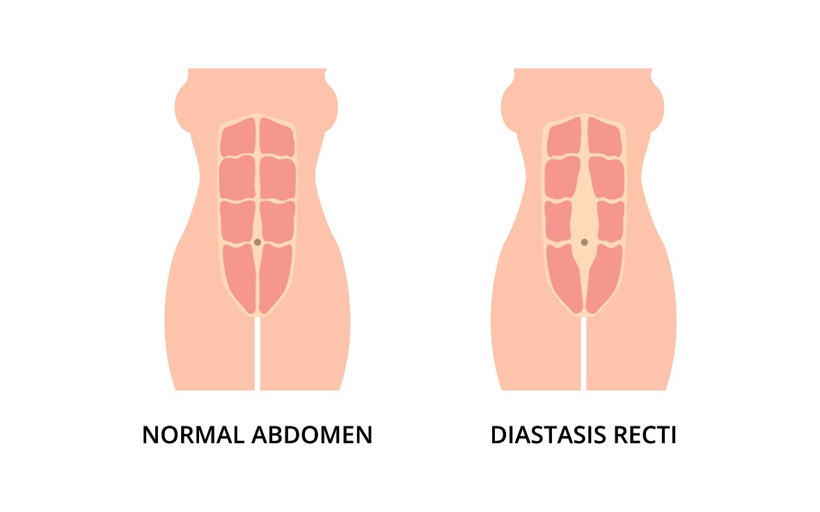 Fyziologický stav břišního svalstva a diastáza (rozestup) levého a pravého přímého břišního svalu od středové čáry linea alba