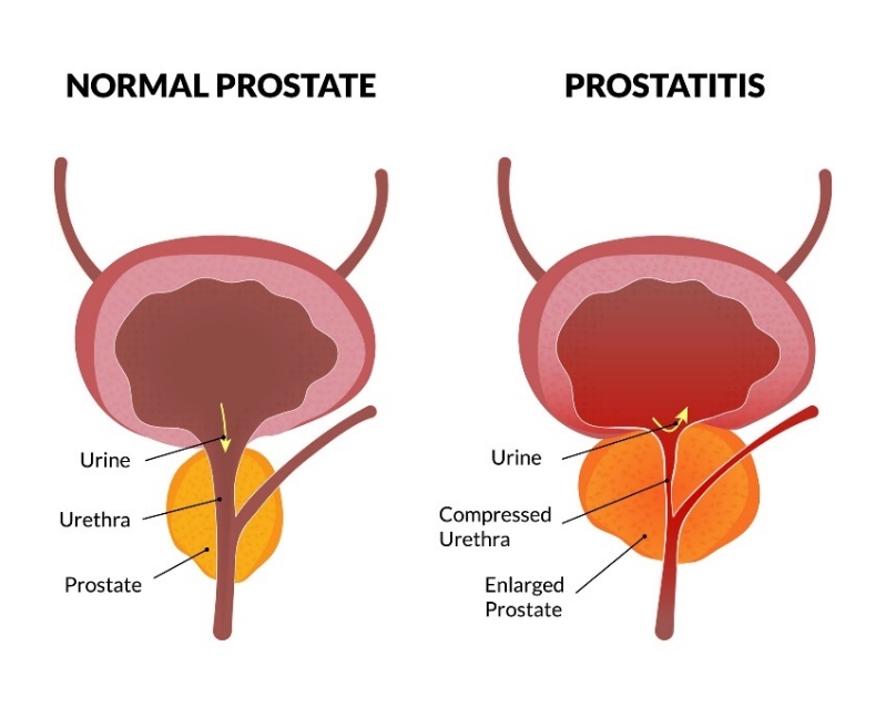 Fyziologický stav prostaty a prostatitida