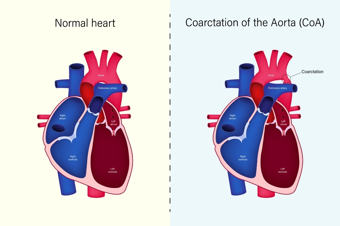 Fyziologický stav srdce a koarktace aorty (CoA)