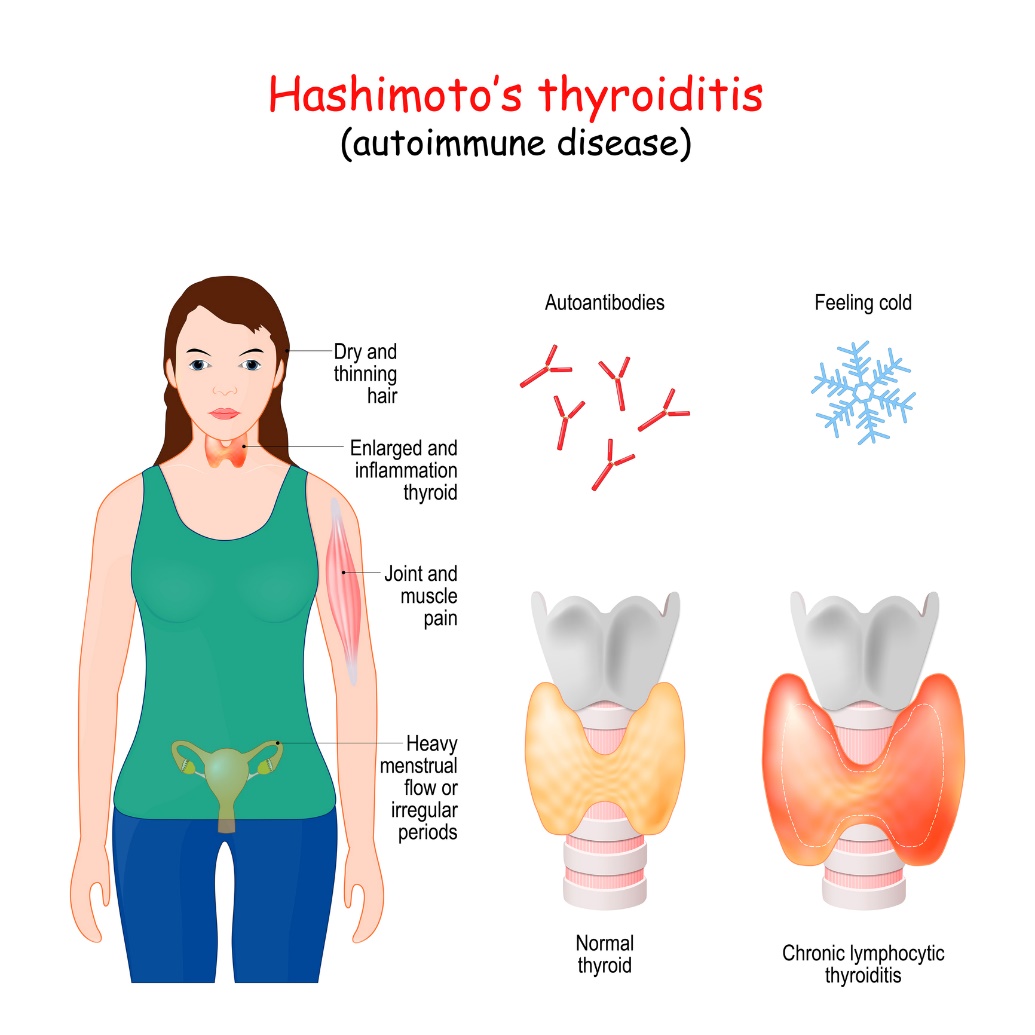 Hashimotova tyroiditida a klinické příznaky