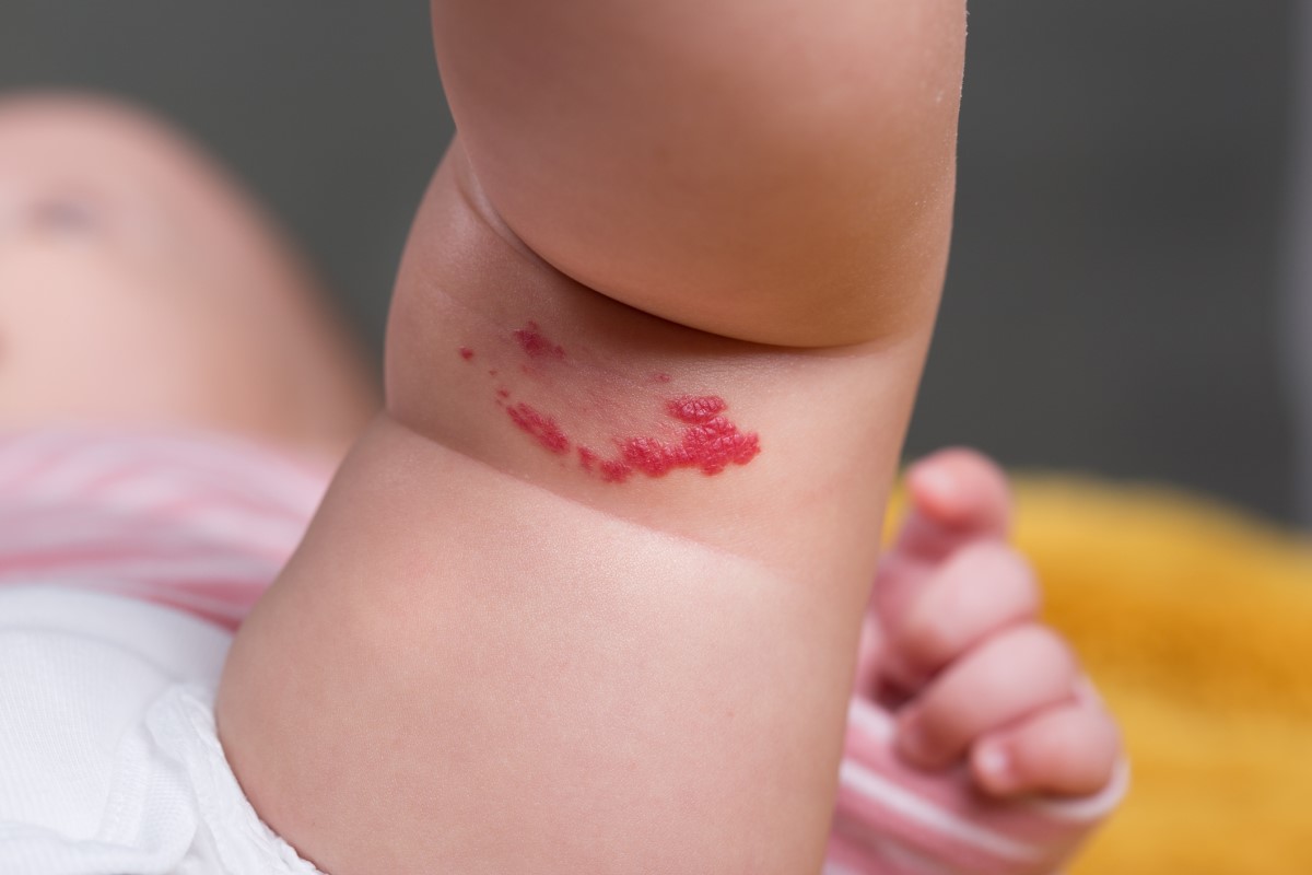 Hemangiom na vnitřní straně stehna dítěte