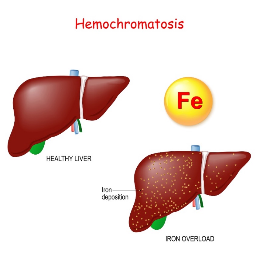 Hemochromatóza: fyziologie a patologie jater s nadměrným ukládáním železa (Fe)