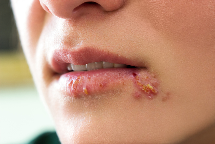 Herpes simplex na tváři - pera a v oblasti ústního koutku