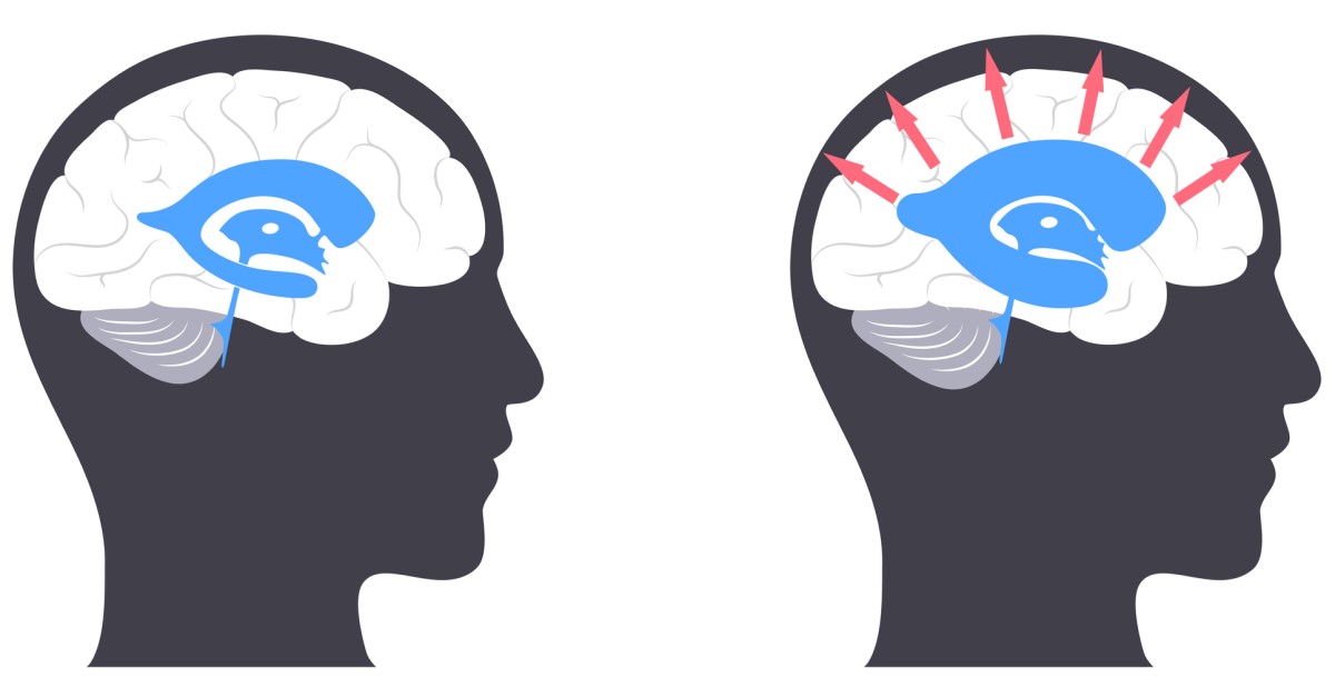 Hlava s mozkem - vlevo normální stav mozku / vpravo - hlava s mozkem s hydrocefalem, kde šipky od středu směrem ven naznačují rozšíření mozkových komor a tlak na mozkovou tkáň.