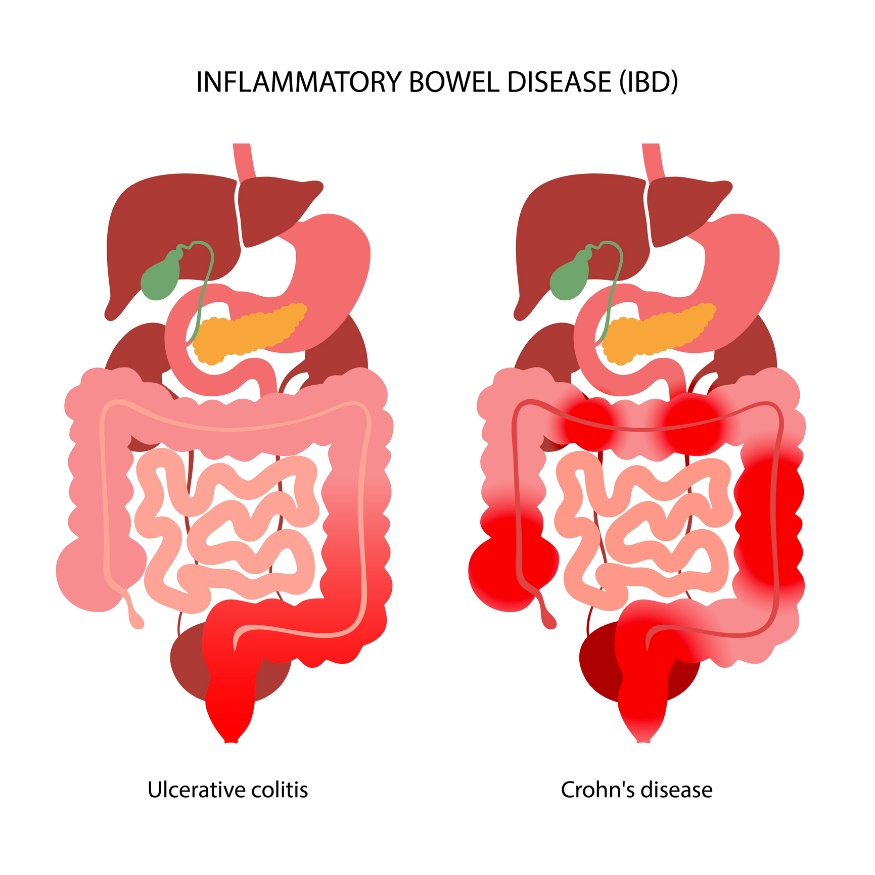 IBD: Rozdělení na ulcerózní kolitidu a Crohnovu chorobu podle lokalizace zánětlivé reakce.