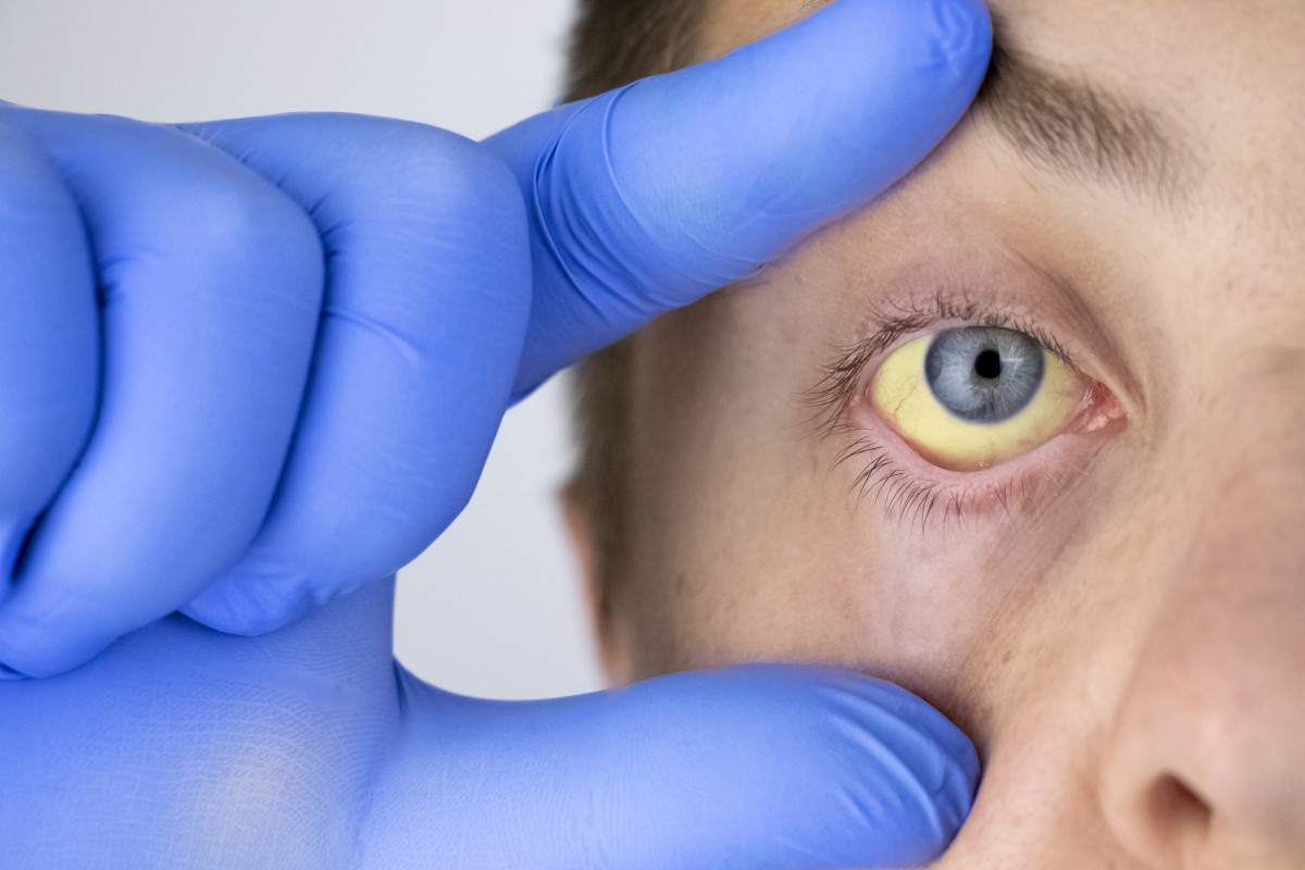 Ikterus, žloutenka - žluté oční bělmo jako příznak poruchy funkce jater.