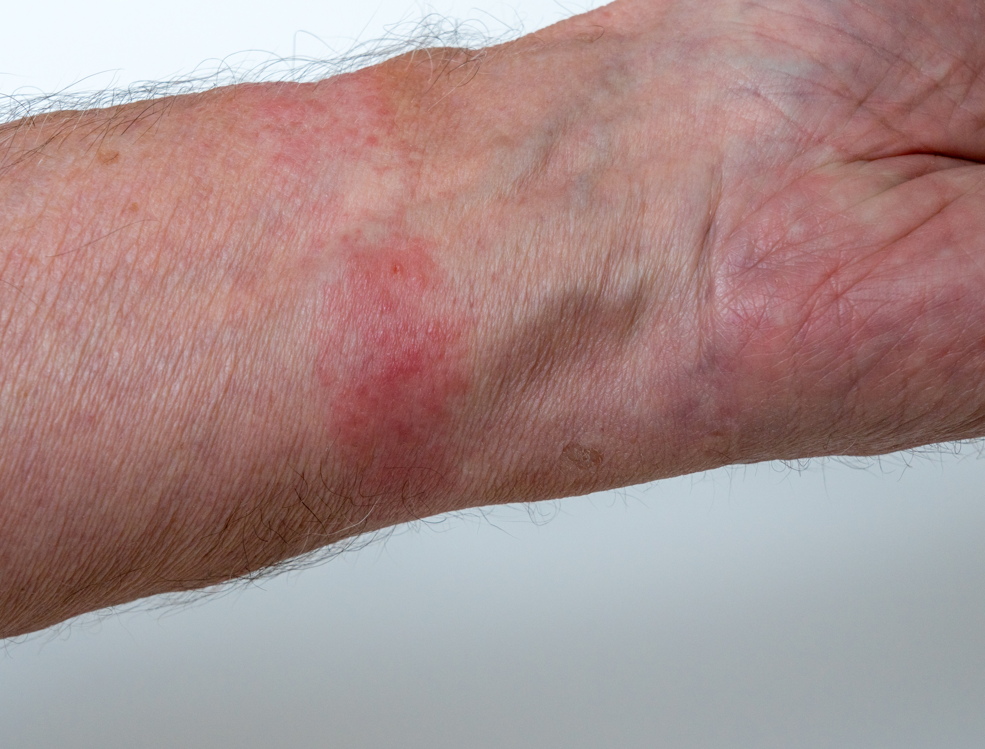 Kontaktní dermatitida na rukou