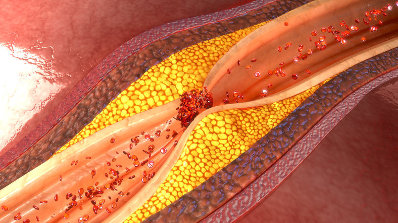 Angina pectoris a ateroskleróza a aterosklerotický plát v koronární neboli srdeční cévě