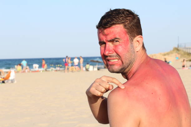 Kůže spálená od slunce je predispozicí vzniku kožních nádorů