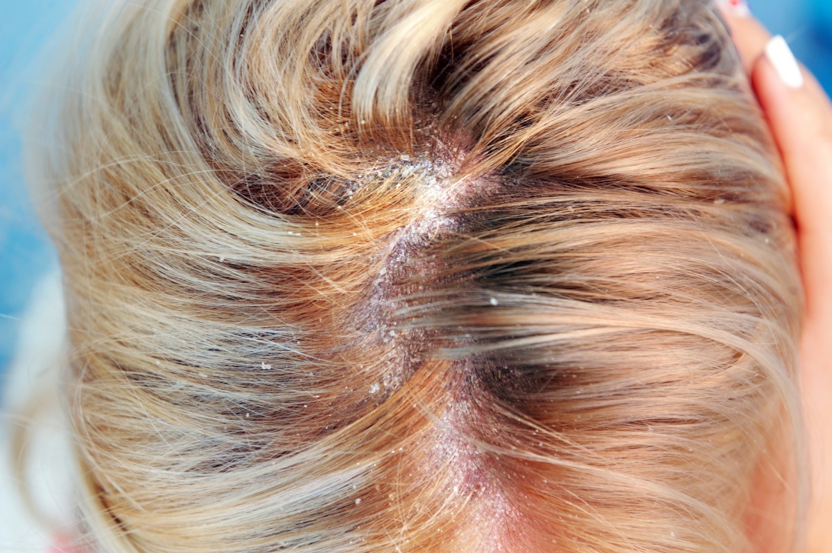 Seborea ve vlasech ženy, lupy u seboroické dermatitidy