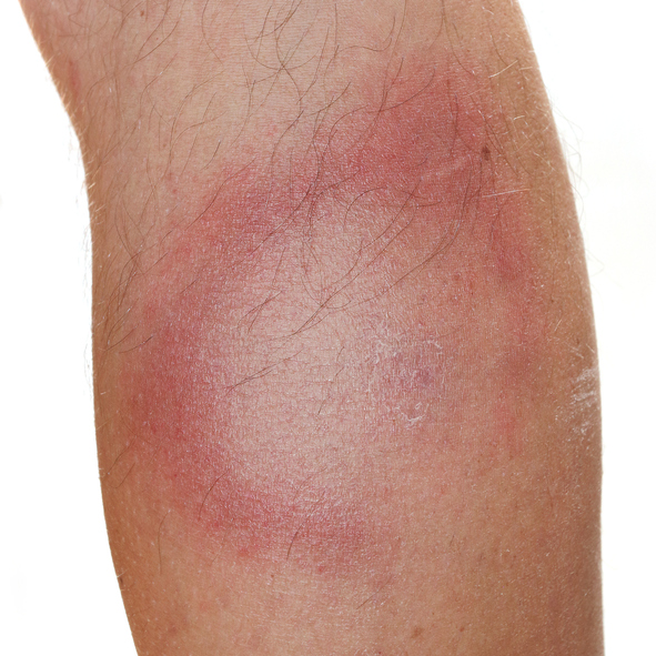 Typický příznak boreliózy, tedy migrující erytém, zarudnutí kůže, s bledým centrem