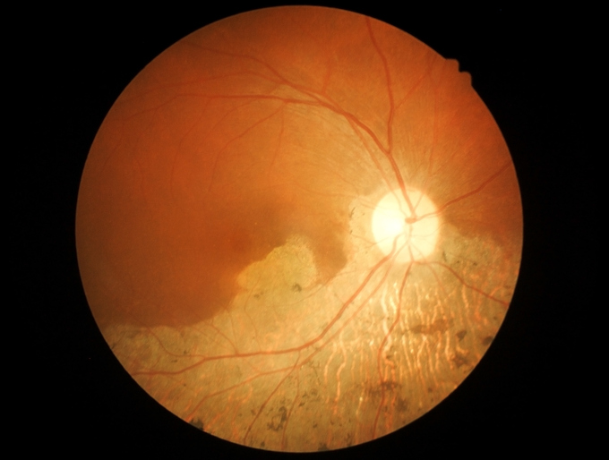 Makulární degenerace při oftalmologickém vyšetření