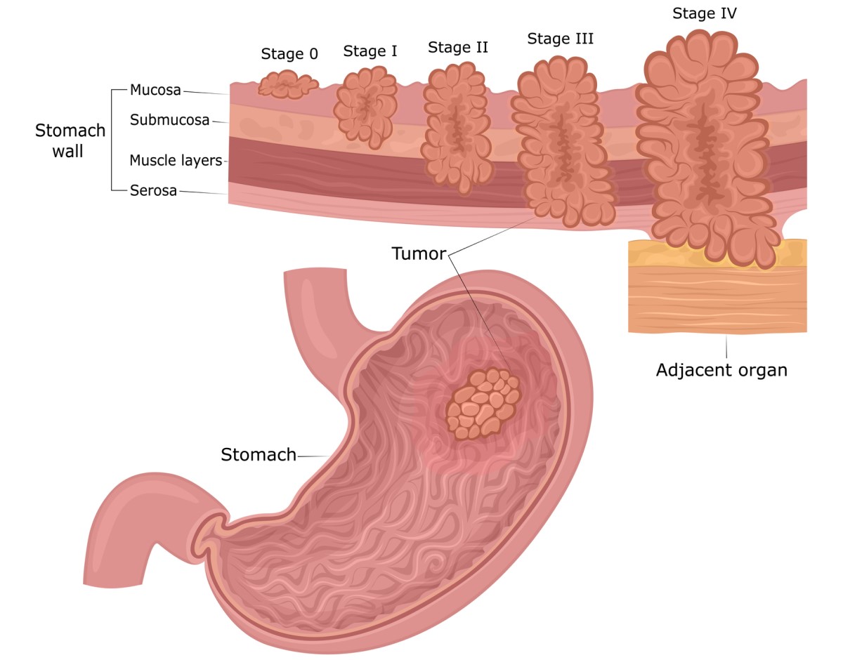 Rakovina žaludku: vrstvy stěny žaludku (sliznice, podsliznice, svalovina, seróza) a stádia vývoje nádoru od sliznice do okolí a orgánů.