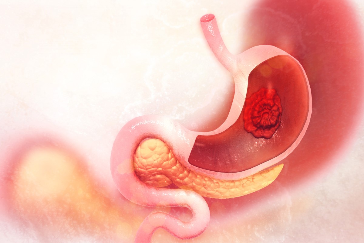 Vizualizace maligního nádoru lokalizovaného v žaludku.