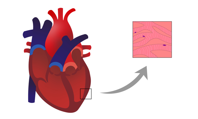 Myokarditida: zánětlivý proces s infiltrátem a degenerací kardiomyocytů ve stěně srdečního svalu.