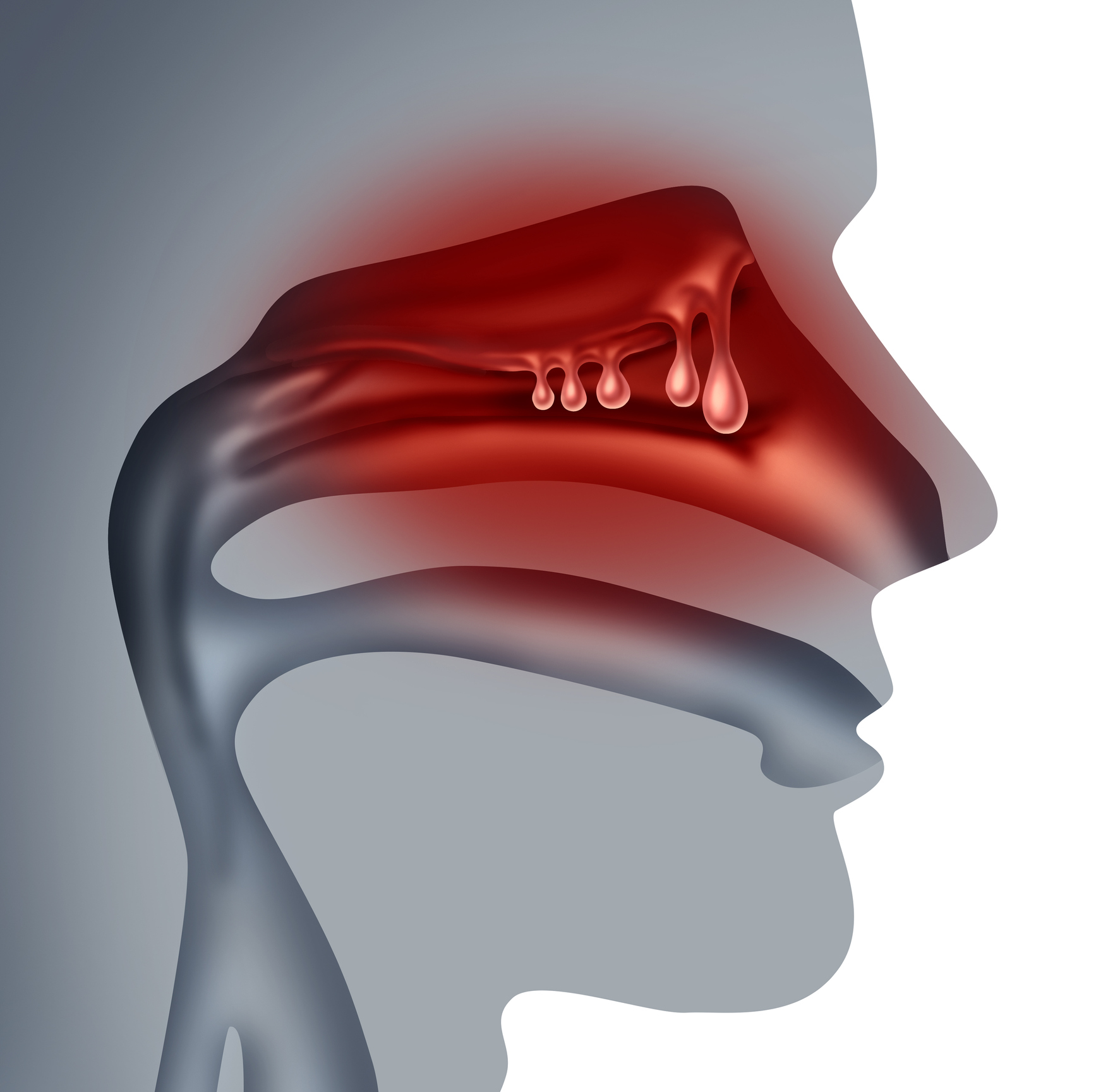 Nosní polypy jsou výrůstky na sliznici nosní dutiny nebo vedlejších nosních dutin, které vznikají v důsledku dlouhodobých nebo opakovaných zánětů nebo alergií. Zdroj fotografií: Getty Images Nosní polypy jsou výrůstky na sliznici nosní dutiny nebo nosních dutin.