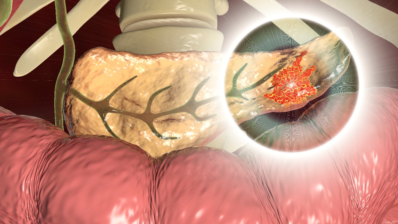 Pankreatitida - napadená část slinivky břišní - ocas slinivky břišní, anatomické zobrazení
