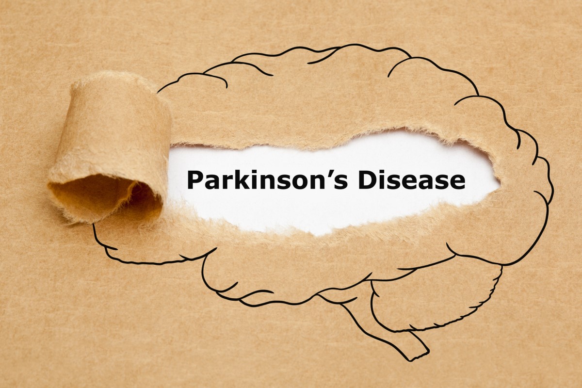 Morbus parkinson = Parkinsonsova choroba = Parkinsonova choroba - animace mozku s Parkinsonovou chorobou uprostřed