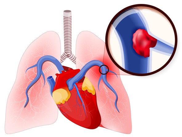 Plicní embolie, uzavření plicní artérie krevní sraženinou