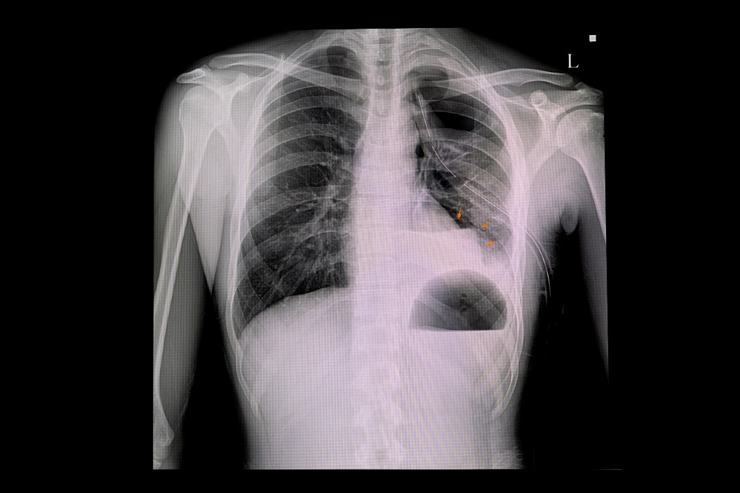 Rentgenový snímek pneumotoraxu levé plíce a nahromadění vzduchu v pohrudniční dutině hrudníku (bílá barva)