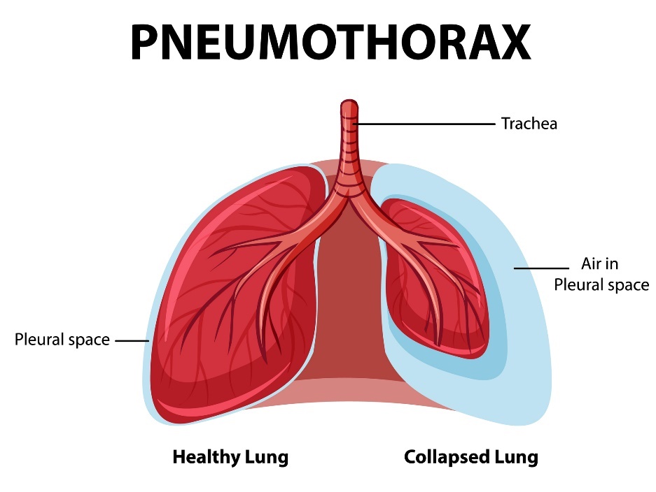 Pneumotorax: zdravé a kolabující plíce