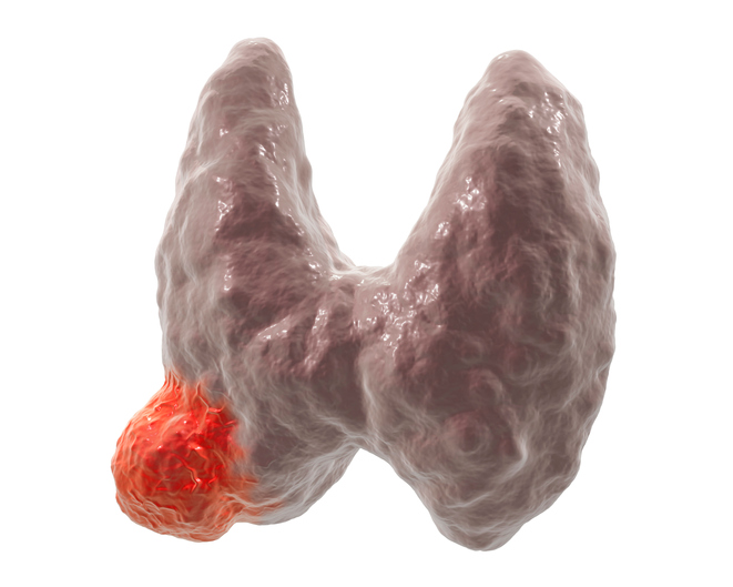 Rakovina štítné žlázy - anatomický obrázek