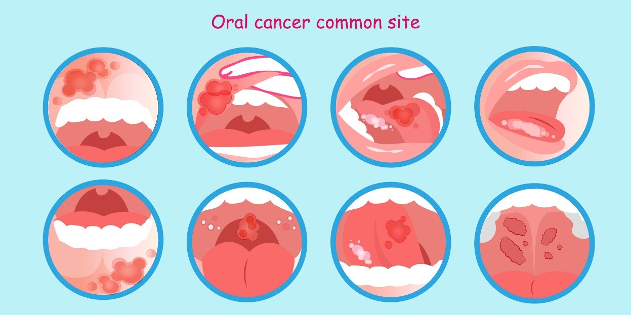 Rakovina dutiny ústní a nádorová ložiska - model