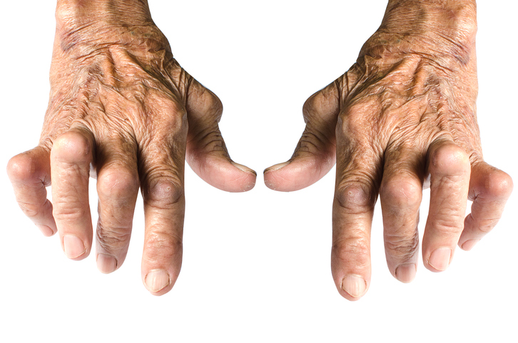 Typické deformity rukou při revmatoidní artritidě