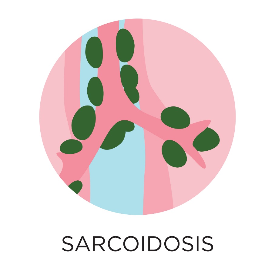 Sarkoidóza – tvorba granulomů