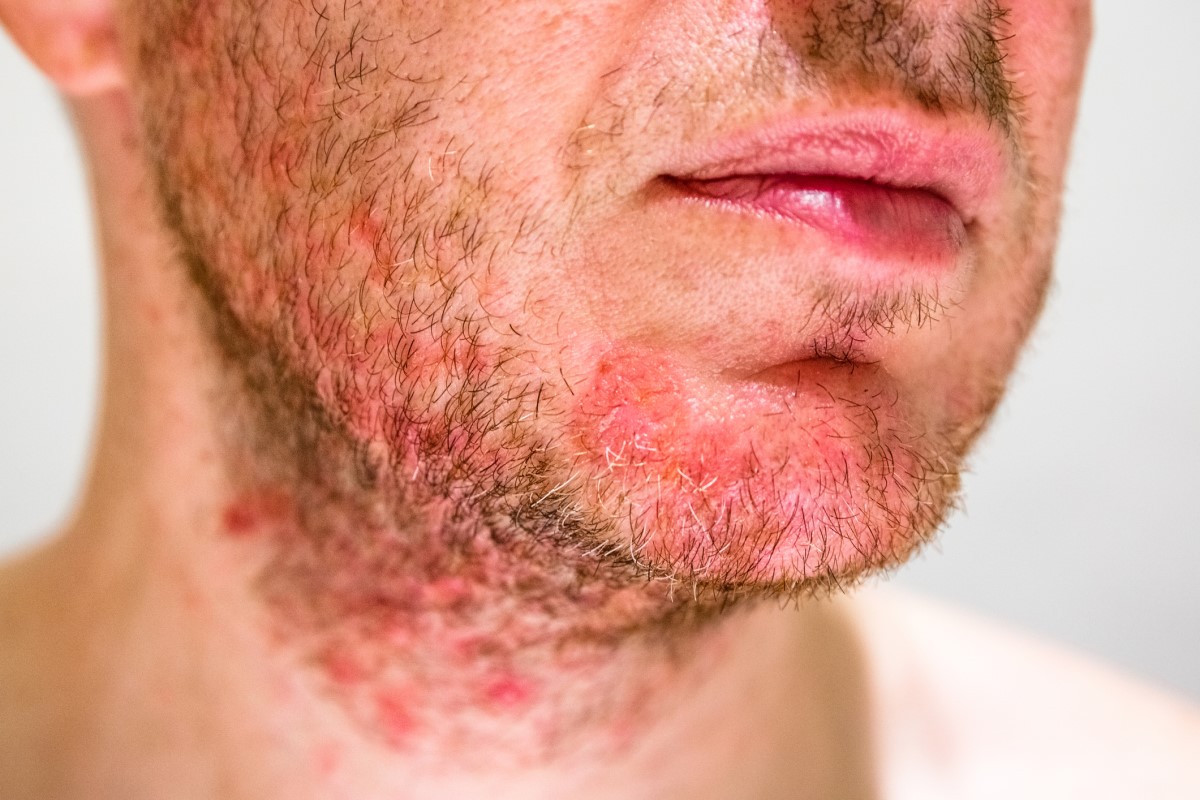 Muž se seboreou na bradě, zarudlý obličej se známkami dermatitidy