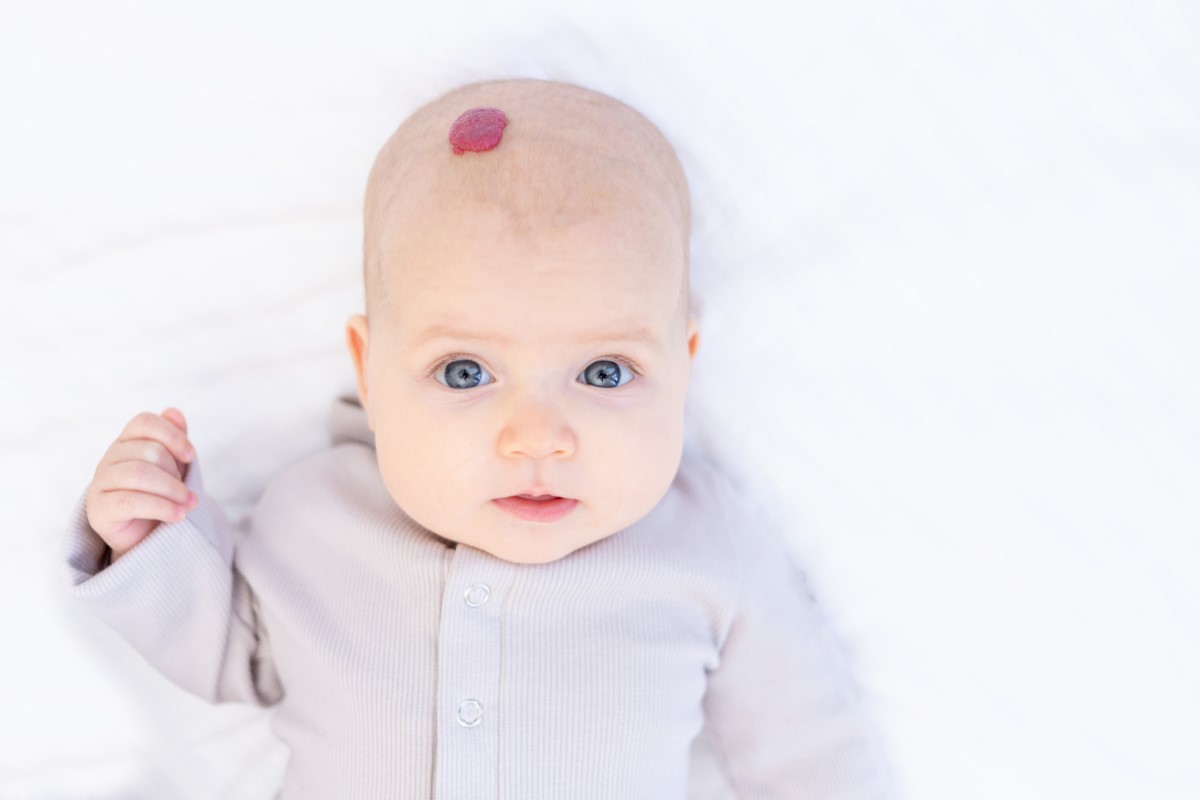 Hemangiom na hlavě dítěte - častý výskyt