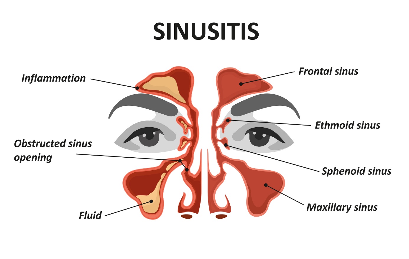 Animovaný model/obrázek sinusitidy a vedlejších nosních dutin