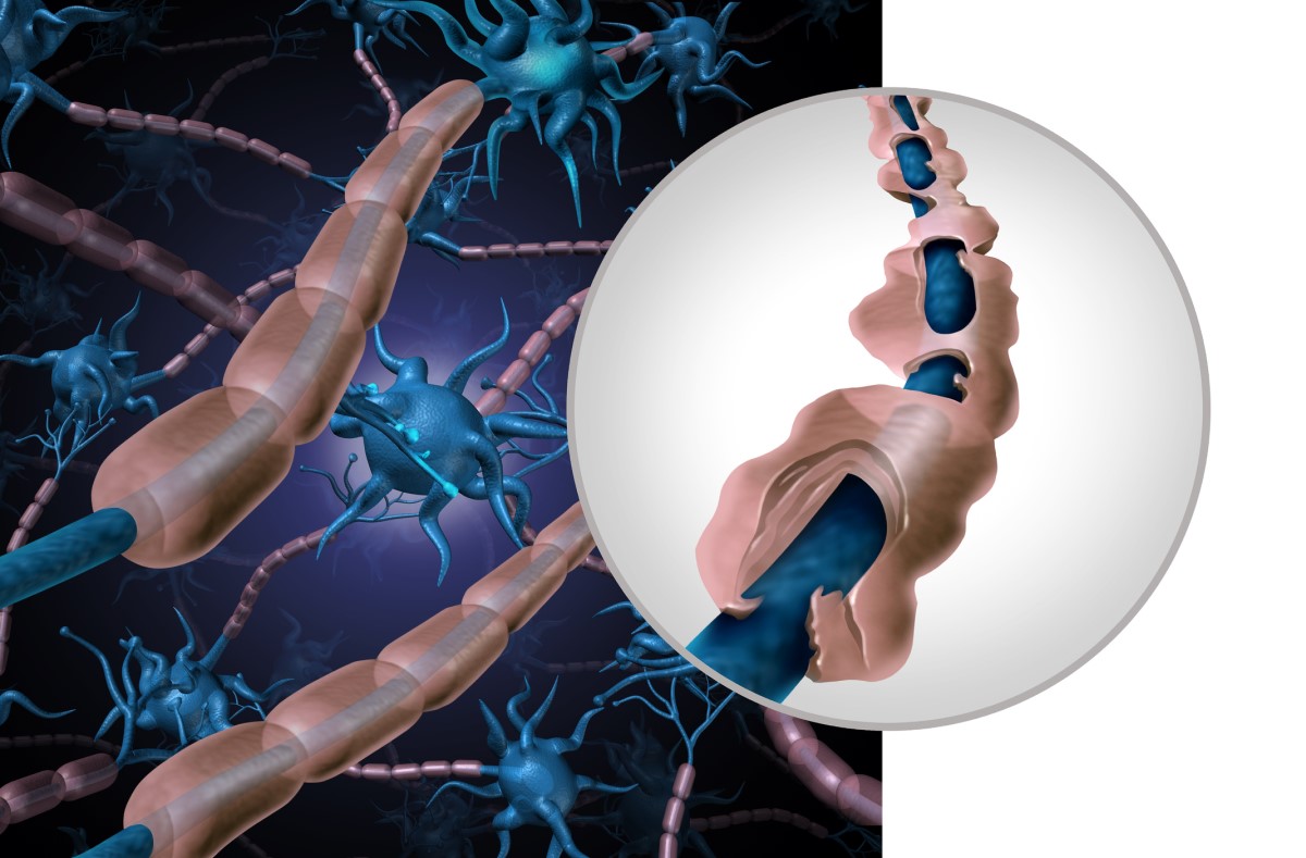 Anatomické, názorné zobrazení zdravého a poškozeného neuronu - demyelinizované vlákno