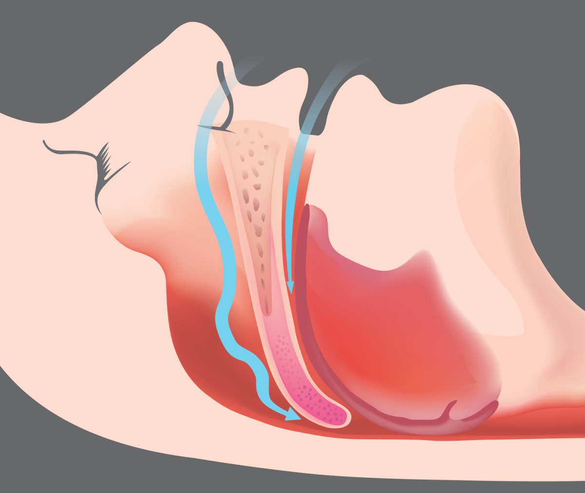 Obstrukční apnoe a obstrukce dýchacích cest - animovaný obrázek a model dýchacích cest
