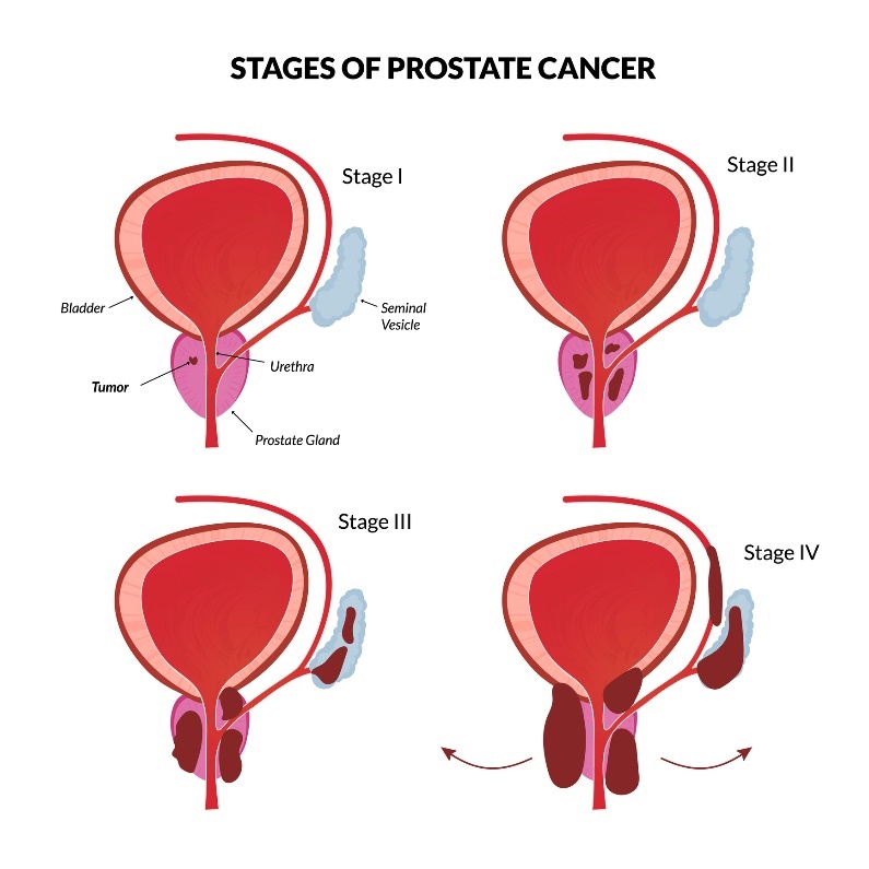 4 základní stadia rakoviny prostaty